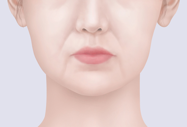 A Complete Summary of 6 Complications After Cheekbone Surgery: Sinusitis, Recurrence, Hollow Cheeks, and Sagging Cheeks image 1