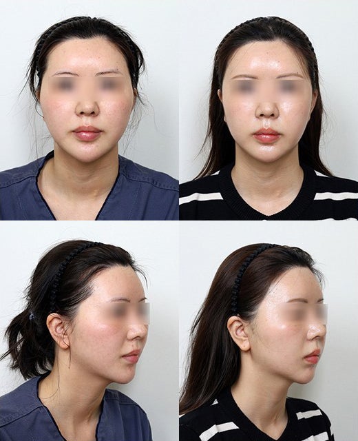배우 하영, 나나 얼굴형 실제 윤곽수술은 어떻게 다를까? 관련 이미지 6