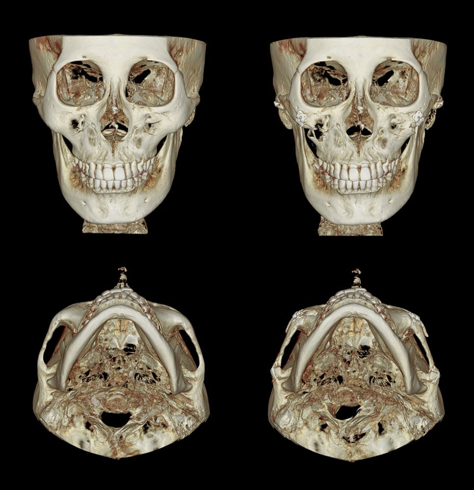 Zygoma Reduction Surgery: Effects and Differences Between 230-Degree and 3D Zygoma Reduction image 7