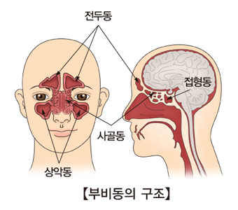 광대수술 부작용으로 발생한다는 부비동염이 무엇일까요? 관련 이미지 3