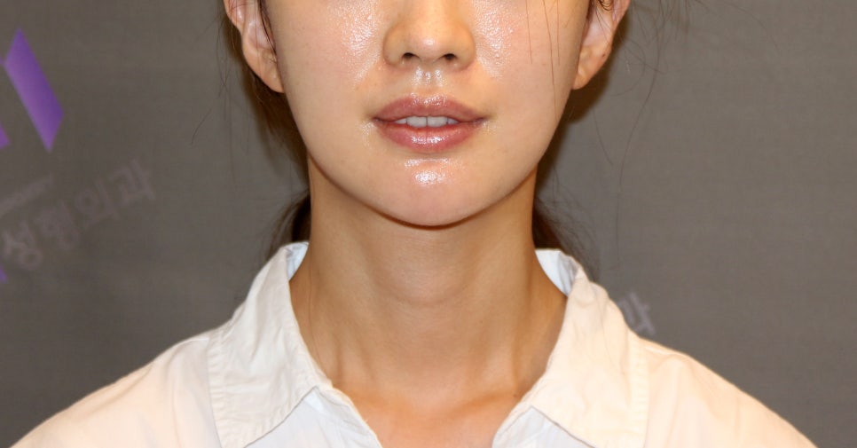 [Chin Surgery] Learning About Contouring Shave and T-Osteotomy with Real Patient Cases (2) image 11