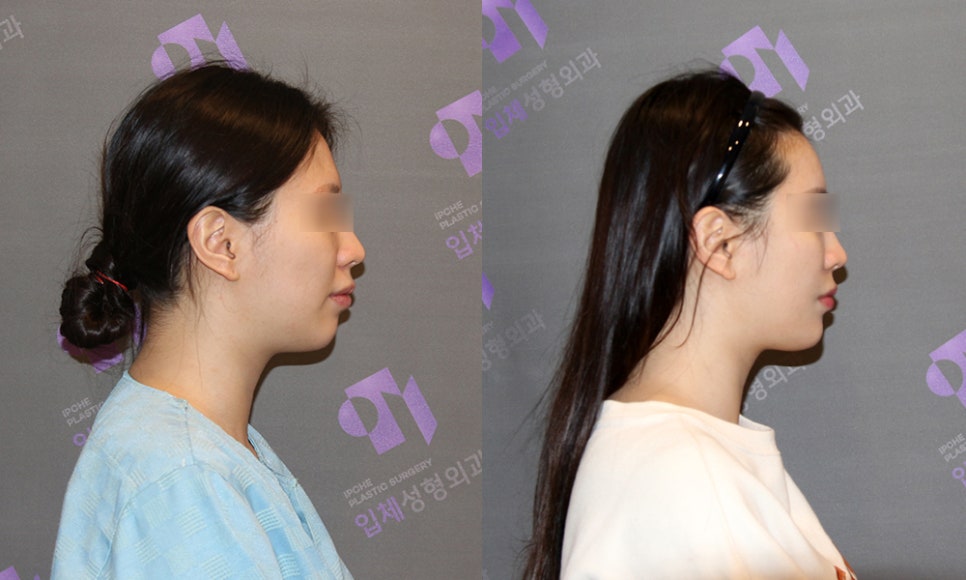 What Surgery Is Best for Correcting a Short Chin or Recessed Chin? The Limits of Chin Surgery and the Actual Results image 12