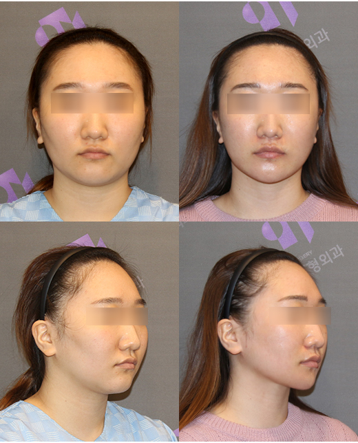 What Procedures Are Good to Have After Facial Contouring Surgery? image 4