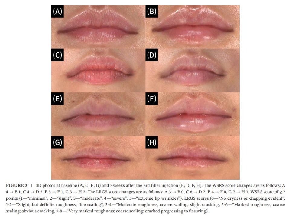 [Paper Review] What Is the Trending Lip Rejuran, "Lipjuran"? image 5