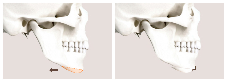 Can Chin Advancement Surgery Adjust Chin Length? image 5