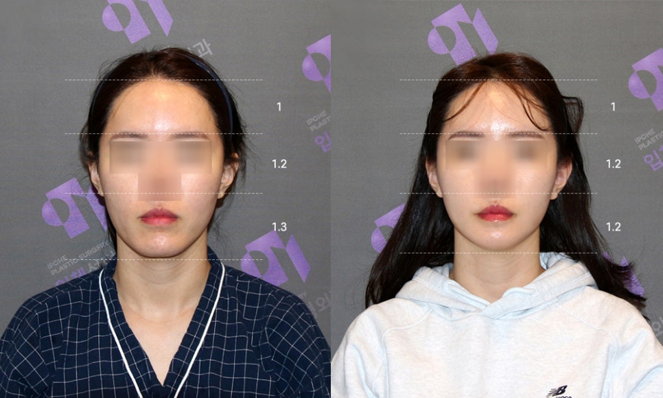 긴턱수술 후 중안면부 얼굴이 길어 보일까요? 관련 이미지 3