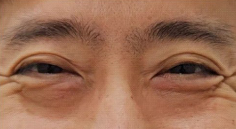 50대 남자눈성형 하안검 수술 케이스 - 세대별 분석으로 접근한 해결 전략 관련 이미지 4