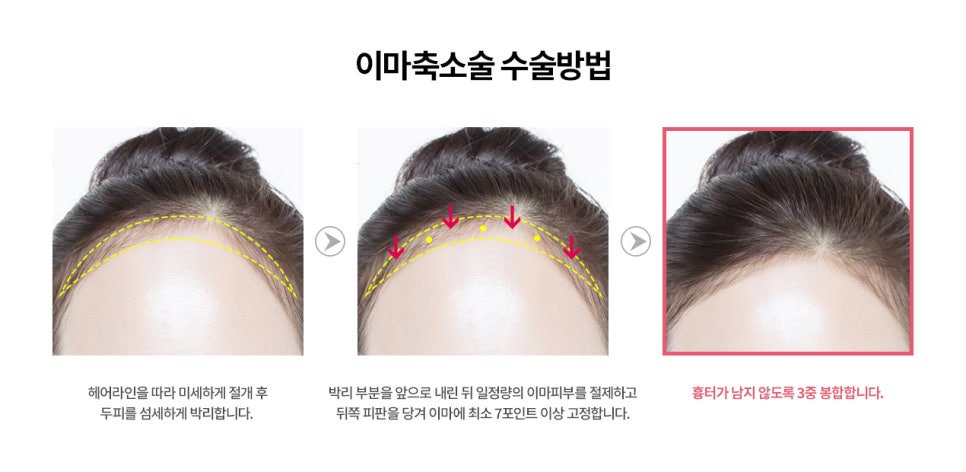 얼굴비율에 맞지 않는 넓은 이마는 어떻게 해결해야 할까요? 관련 이미지 4
