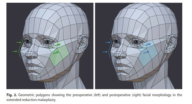 [Paper Review] The Extended Zygoma Reduction Surgery Recently in Vogue in Japan image 4