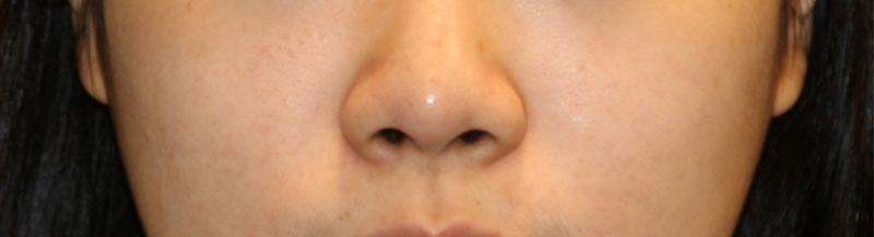 Is There a Nose Alar Reduction Surgery Without Scarring? (Looking at Before-and-After Photos) image 13