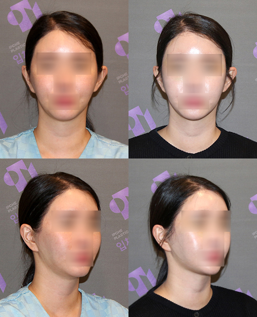 If you’re like this, don’t get contouring surgery!! An absolute no-go face? image 2