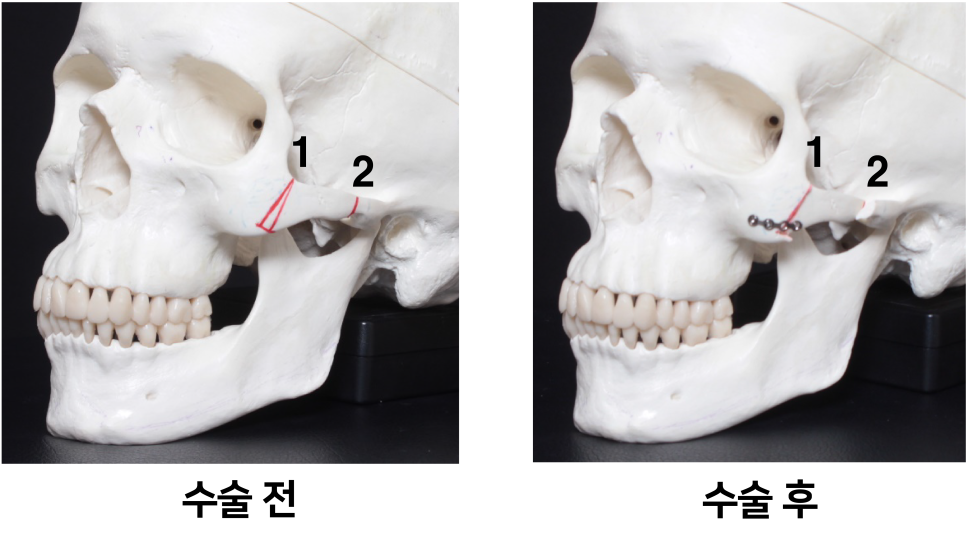 Lateral Cheekbone Reduction, 230-Degree Three-Dimensional Cheekbone Reduction from the Front to the Side image 1