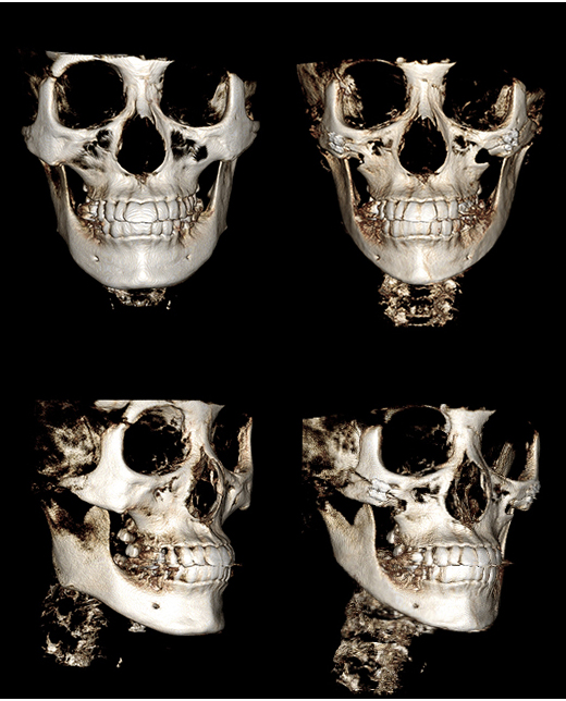 Anesthesia Accidents in Facial Contouring Surgery, Death Cases - Explained by a Plastic Surgery Specialist image 2