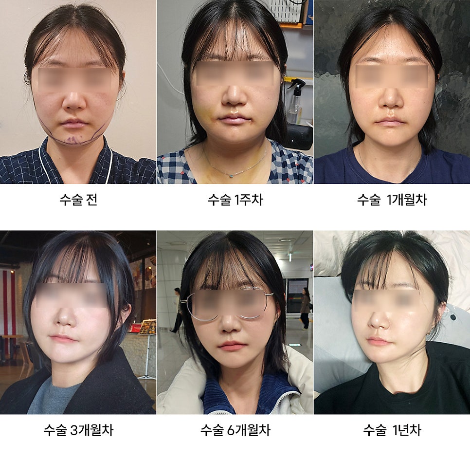 How Long Do Facial Contour Changes Continue After Facial Bone Contouring Surgery? (Day 1 to Day 365) — See With Photos image 12