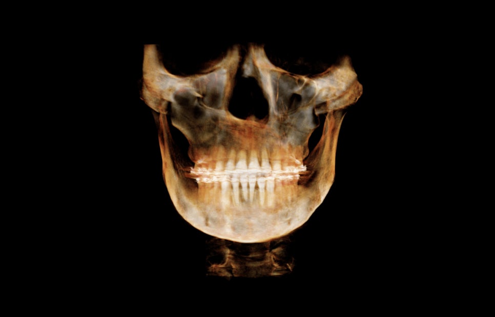 Is It Necessary to Remove the Fixation Pins After Facial Contouring Surgery? image 10
