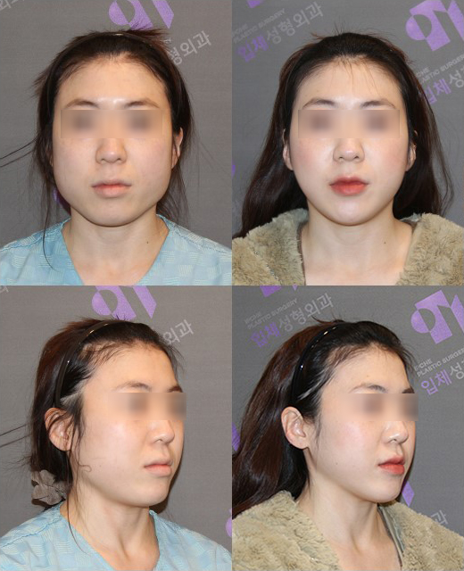 이런 분들은 윤곽수술 대신 다른 수술을 먼저 생각해보세요! 관련 이미지 4