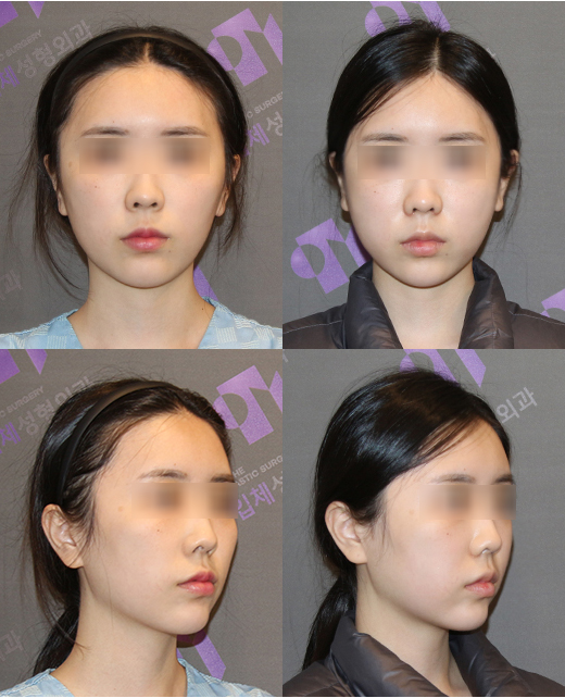 안면윤곽수술 몇 살부터 가능한가요? - 성형외과 전문의가 알려드립니다. 관련 이미지 4
