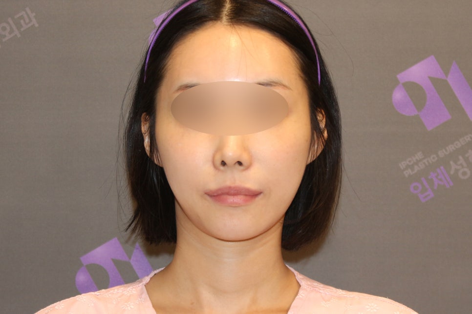Lateral Cheekbone Reduction Surgery Review: Looking at Real Cases image 1