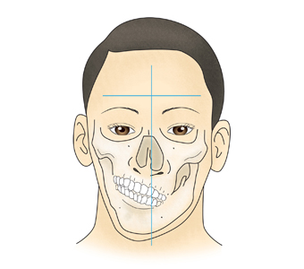 Which Surgery Do I Need: Contouring Surgery or Double-Jaw Surgery? image 4
