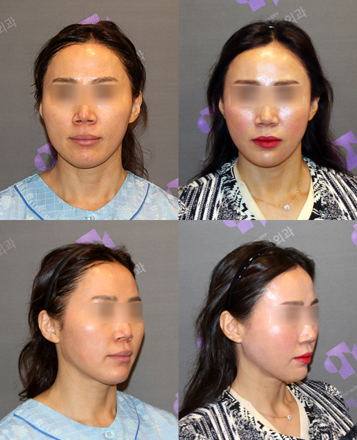 After zygoma reduction surgery, the cheek sagging is severe — is it because of dissection? image 6