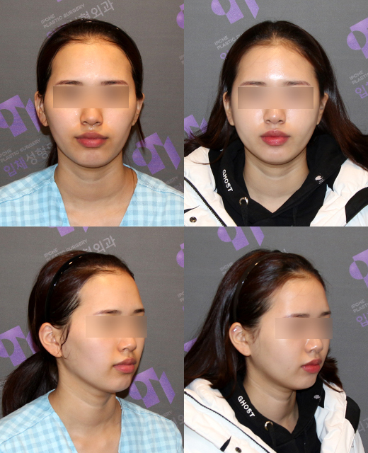 How effective is the incision method compared to the non-incision method for cheek hollow correction? image 1