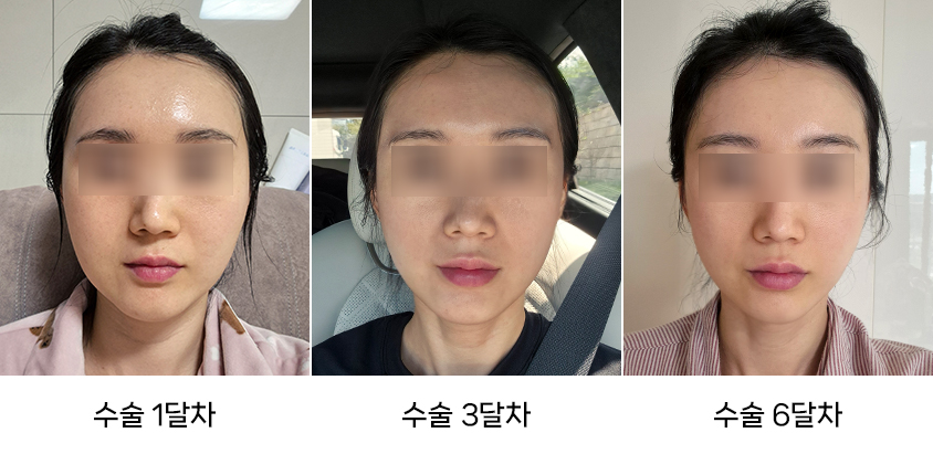 The Difference Between Swelling and Cheek Sagging After Facial Contouring Surgery image 2
