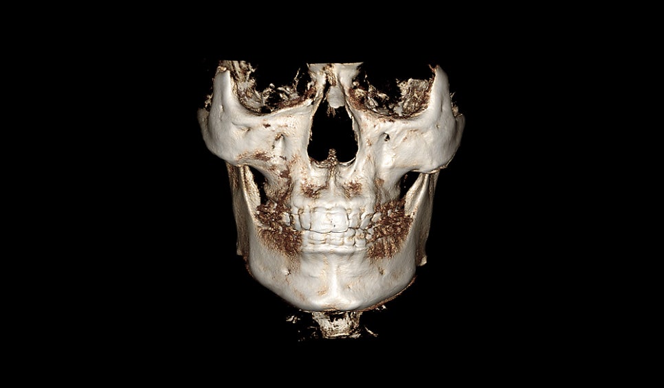 Why Is Male Cheekbone Reduction Different from Female Cheekbone Reduction? image 1