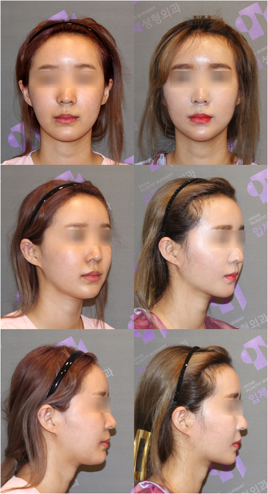 Let’s Take a Closer Look at Submental Muscles and Submental Muscle Tightening for a Double Chin image 2
