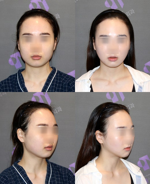 Is it good to combine facial contouring surgery with buccal fat removal? image 4