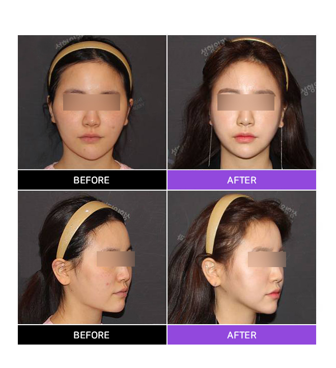 Sunken Cheeks!? It’s Not a Side Effect of Zygoma Surgery! image 5