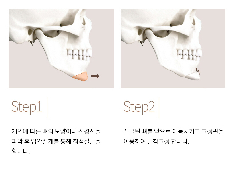 Chin Implants and Chin Advancement Surgery: Real Surgical Cases and What to Know image 4