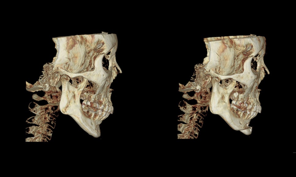 Can Chin Advancement Surgery Adjust Chin Length? image 7