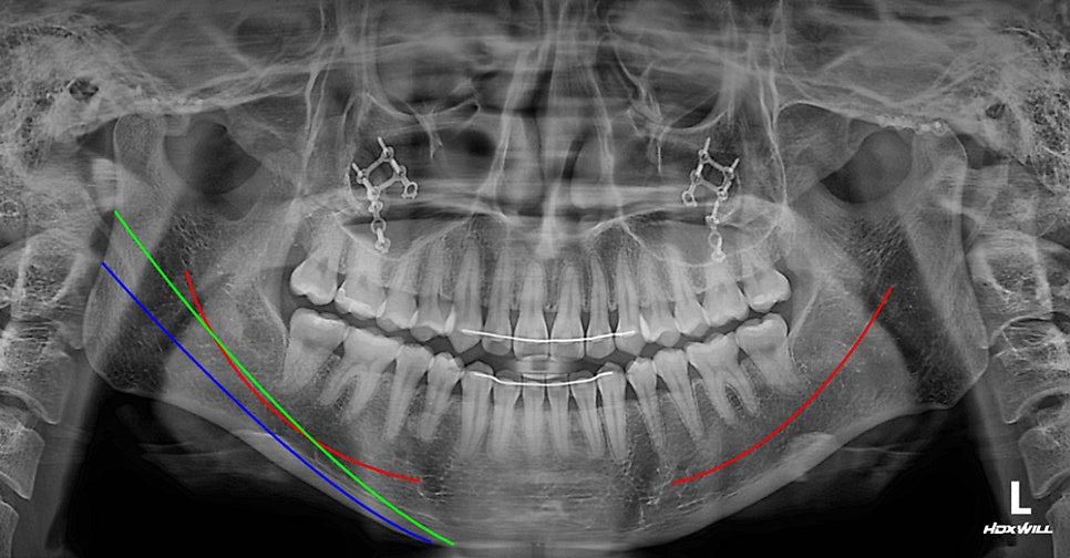 What Side Effects Can Occur Due to Excessive Bone Resection in Facial Contouring Surgery? image 3