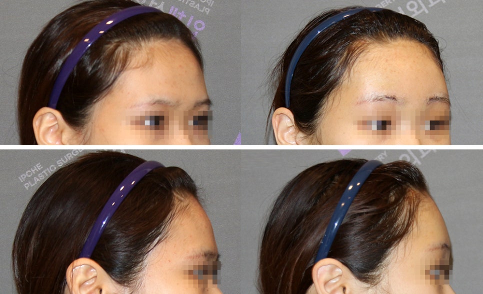 How Should Brow Bone Prominence Be Addressed? image 5