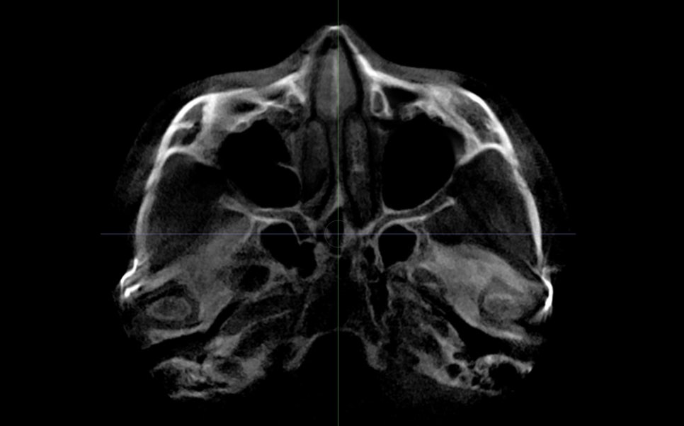 Cheek Sagging? Nonunion? Hollow Cheeks? A Complete Guide to 6 Side Effects of Zygoma Surgery image 8