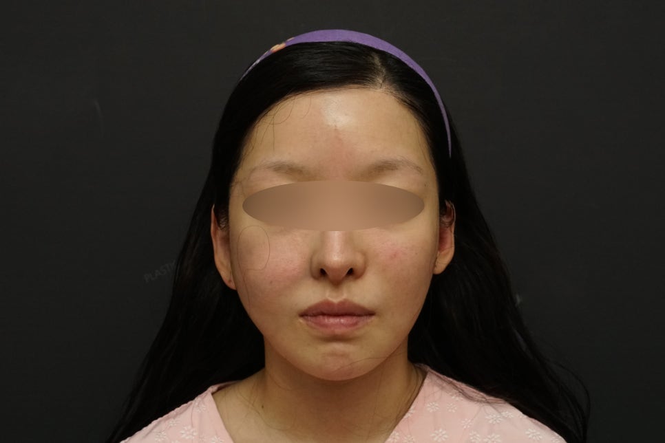 안면윤곽 볼처짐100%온다? 광대수술 부작용 총정리 | 上편 관련 이미지 2
