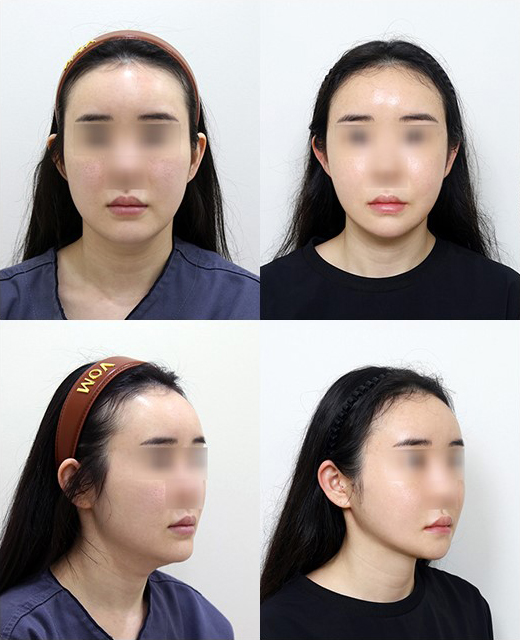 땅콩형 얼굴, 안면윤곽 수술로 해결할 수 있을까요? 관련 이미지 9