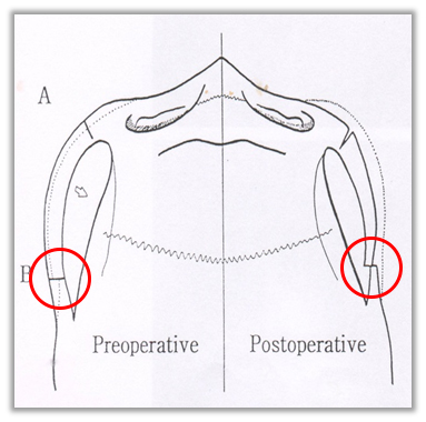 Will cheekbone reduction surgery also make the face smaller? : Learn about how to reduce prominent cheekbones with real surgical cases image 1
