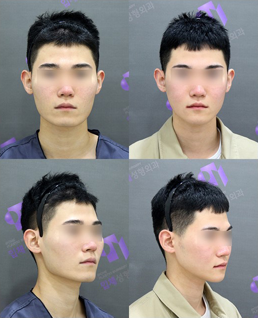 Facial Contouring A to Z: What Is Contouring Surgery? image 11
