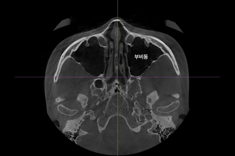 윤곽수술 후 기침과 피가래, 왜 생기고 언제까지 지속될까요? 관련 이미지 2