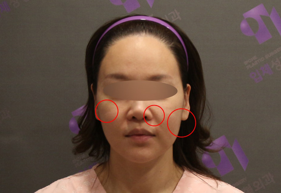 양악수술 후 부작용은 어떤 것이 있을까요? 관련 이미지 5