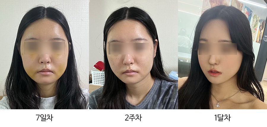 안면윤곽수술 후 붓기, 일차별(1일~30일차) 사진과 함께 회복기간 알아보기 관련 이미지 2