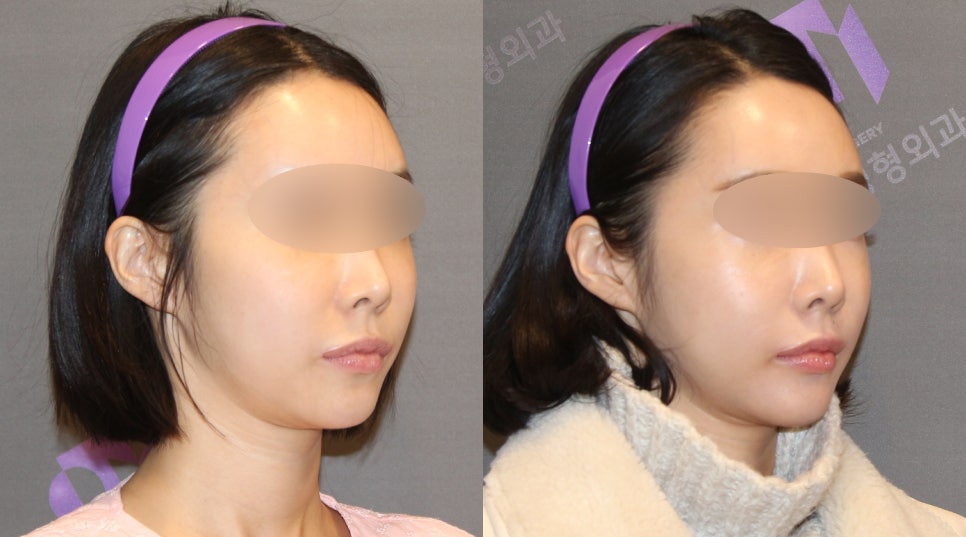 Lateral Cheekbone Reduction Surgery Review: Looking at Real Cases image 6