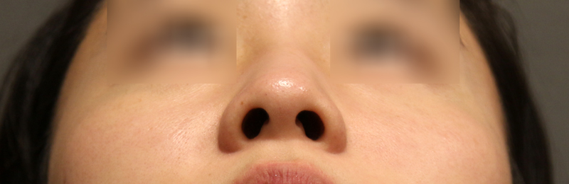 Is There a Nose Alar Reduction Surgery Without Scarring? (Looking at Before-and-After Photos) image 6