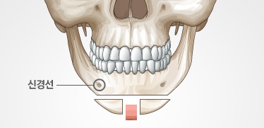 What Is Chin Surgery? image 2
