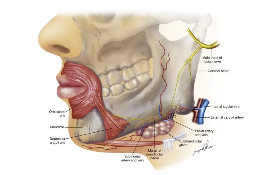 Side Effects After Facial Contouring (Square Jaw, Chin Tip) Surgery: Double Chin and Salivary Gland Enlargement image 4