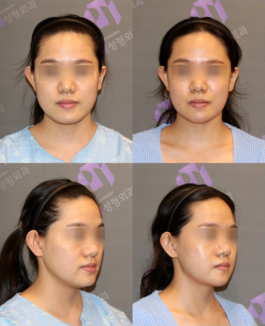 Is There a Way to Address the Secondary Angle That Appears After Chin Surgery? image 3