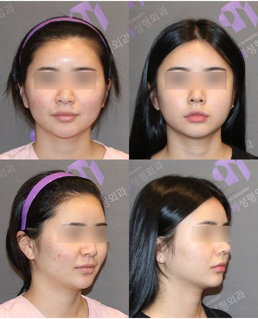 Will cheekbone reduction surgery also make the face smaller? : Learn about how to reduce prominent cheekbones with real surgical cases image 7