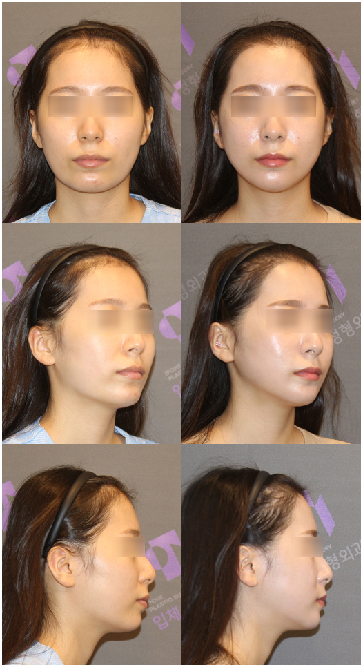 [Chin Surgery] Learning About Contouring Shave and T-Osteotomy with Real Patient Cases (2) image 8