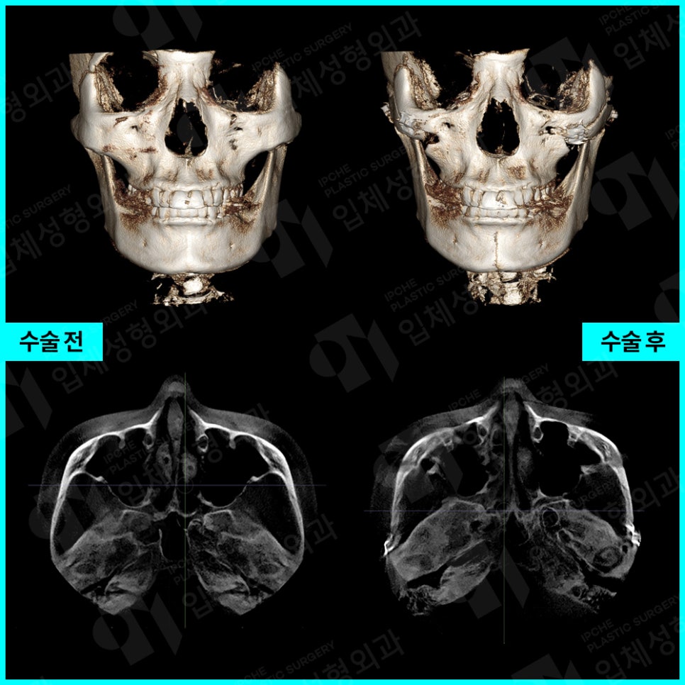 Zygoma Reduction Surgery: Quick Zygoma vs. 3D Zygoma Surgery Differences in Effect and Selection Criteria image 7